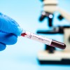 Duchennova mišična distrofija