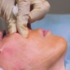 mohs-surgery---procedures--preparation--cost--and-recovery.jpg