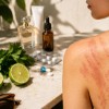 fotodermatitis (1).jpg