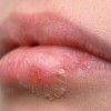 herpes2.jpg
