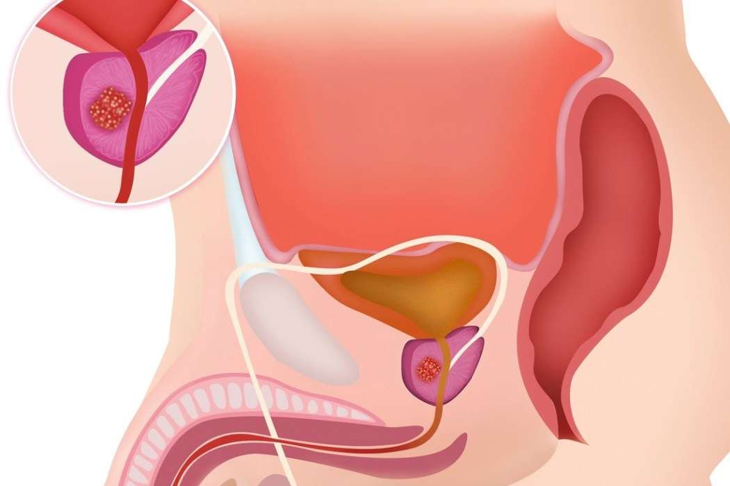 rak prostate