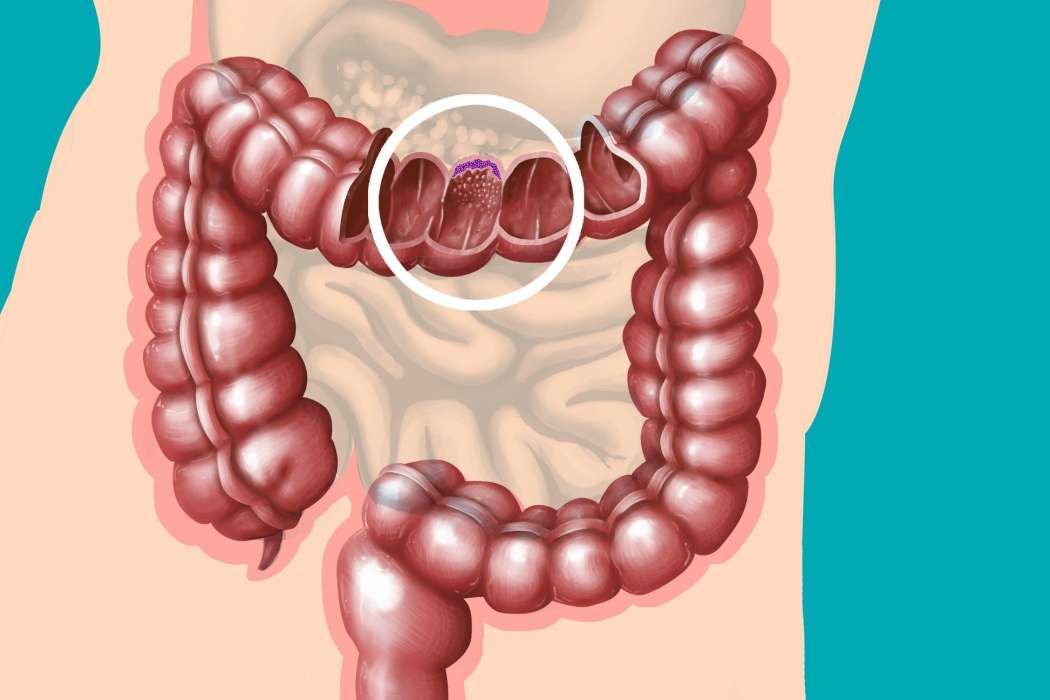 Rak debelega črevesa in danke