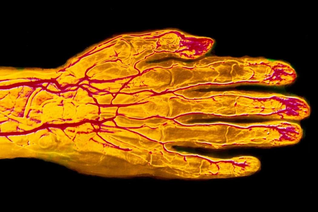 Arterial aneurysm roka profimedia