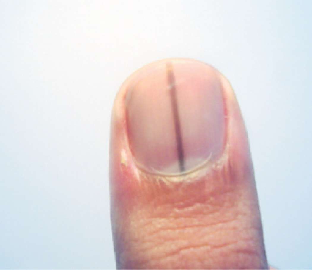 fingernail-300x259