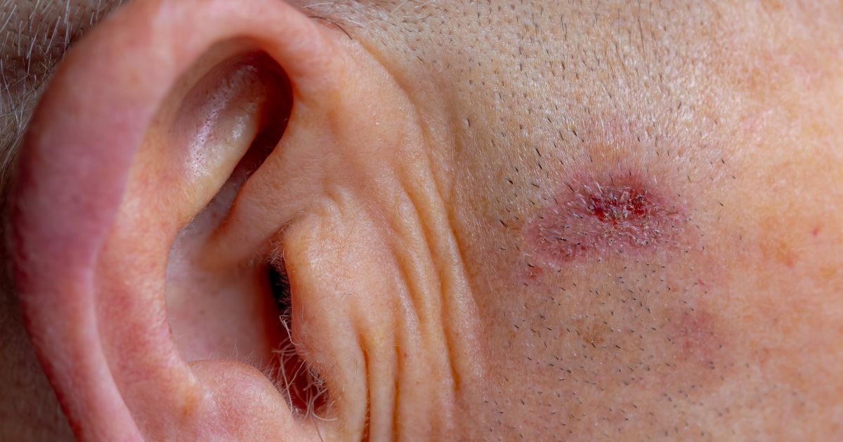 Najpogostejši kožni rak, ki ga ne smete spregledati - Svet24.si