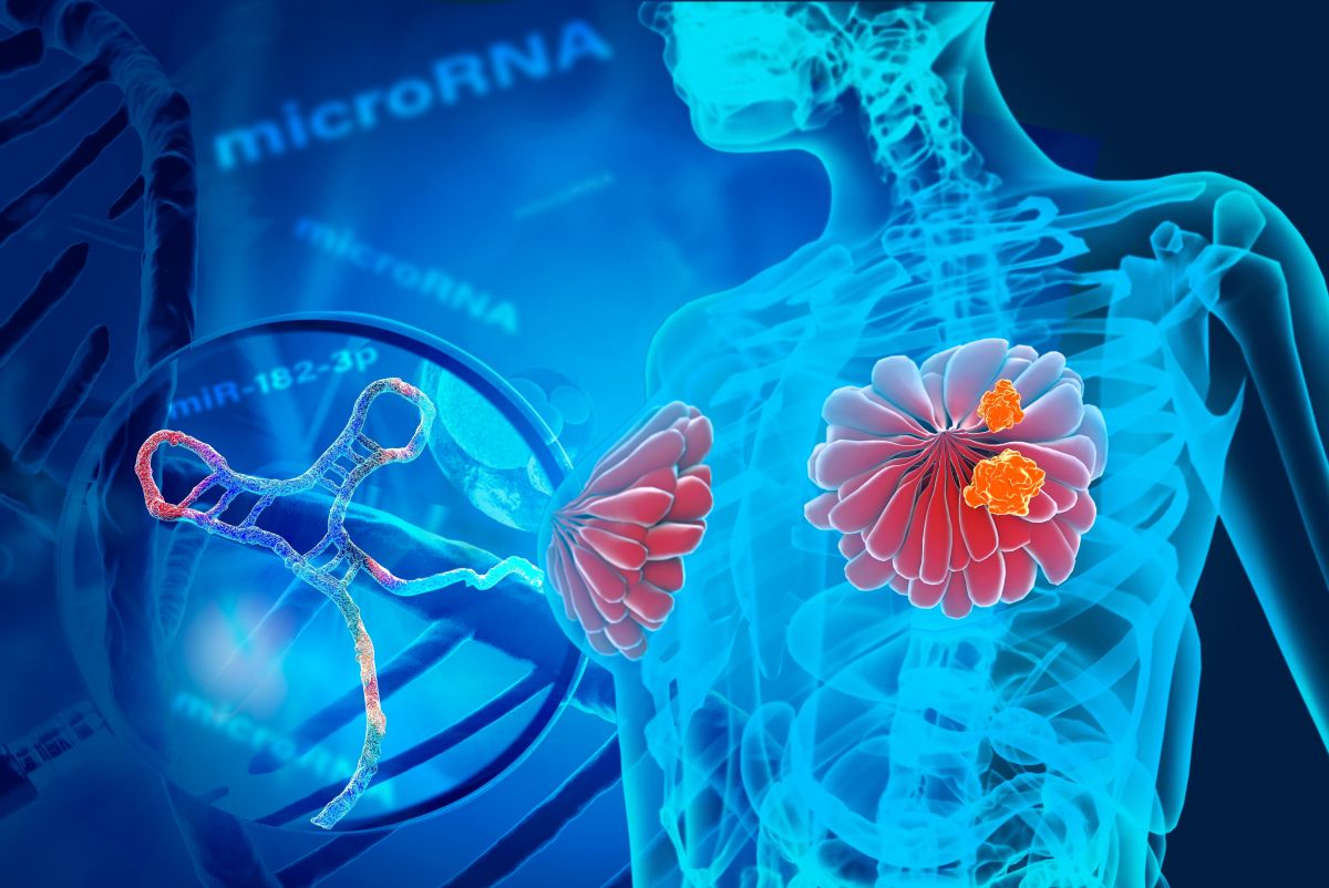 Revolucija zdravljenja raka dojk? Cepivo, narejeno za vsako bolnico ...