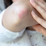 luskavica, suha koža