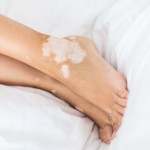vitiligo