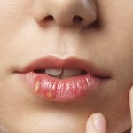 herpes, sonce