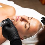 Microneedling