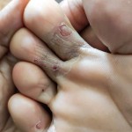 glivice, atletsko stopalo