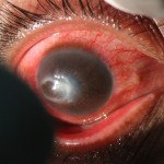 Akantamebni keratitis