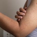 keratoza pilaris, pikice, roke, izpuščaji, koža