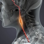 tumor4