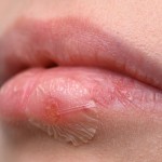 herpes2