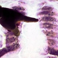 azbestoza azbest pljuča bolezen anhovo tony