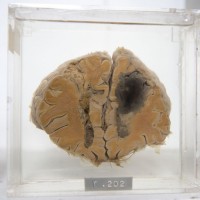 Lobotomised-Brain