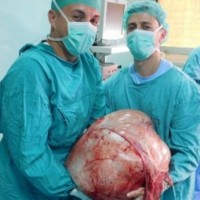 kirurgi odstranili tumor 31 kilogramov Banka Luka