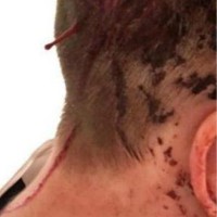 grosskreutz poskodba