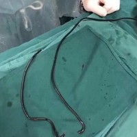 kabel, penis, operacija