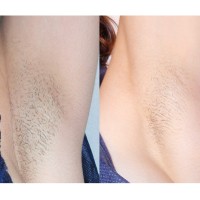 Armpits_before and after