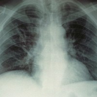 pljuča, rentgen, pljučnica