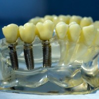 zobni vsadek, implant
