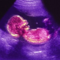 zarodek, fetus