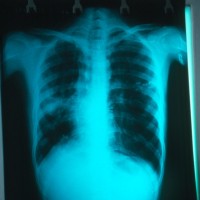 tuberkuloza, rentgen