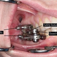 dentalslim-diet-control, dieta