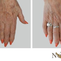 nobilis-before-after-pigmentacij-4330ae2fec