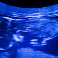 magnetna resonanca, zarodek, fetus