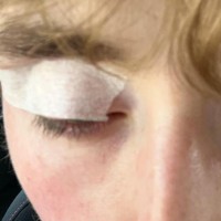 oči poškodba oko
