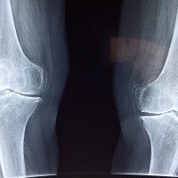 knee-2253047_960_720