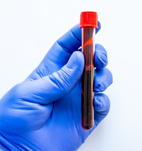 Po krvni skupini lahko predvidevamo bolezni