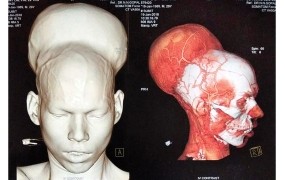 Indijcu odstranili možganski tumor, velik skoraj kot še ena glava