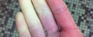 Kaj pomeni, če so prsti nenadoma bledikasti?