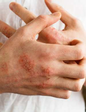 Razširjenost atopijskega dermatitisa strmo narašča.