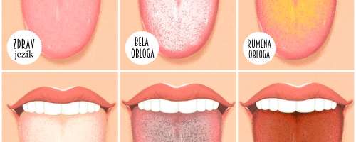 Kaj vam jezik sporoča o vašem zdravju?
