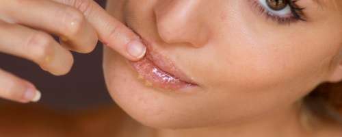 Domača metoda za hitro celjenje razpokanih ustnic