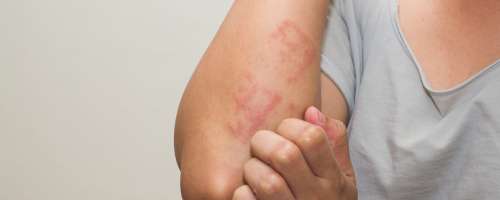 So ti izpuščaji znak za atopijski dermatitis?