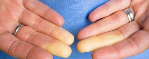 Kaj pomeni, če prsti iznenada postanejo beli?