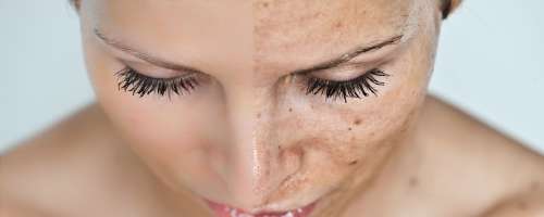 Praktični nasveti pri ličenju pegaste kože