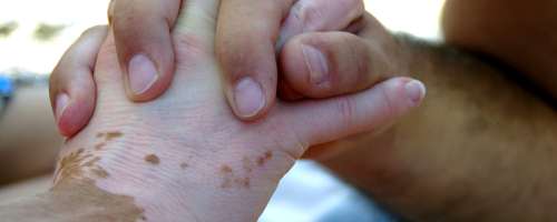 Kdo lahko zboli za nadležnim vitiligom?