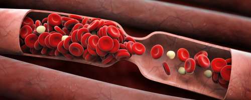 Tveganja za nastanek krvnega strdka