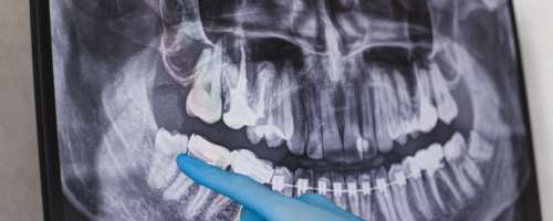 Ko zob povzroča vnetje, zatekanje ter bolečine