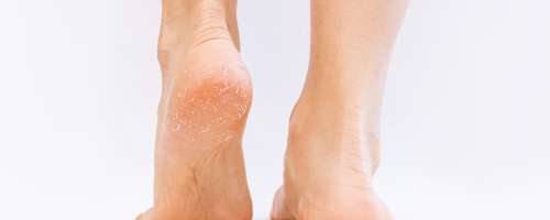 Razpokana koža na petah poveča tveganje za nevarno okužbo