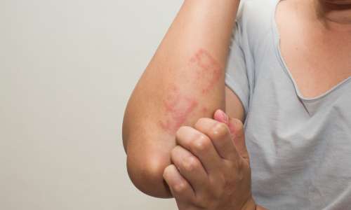 atopic-dermatitis-