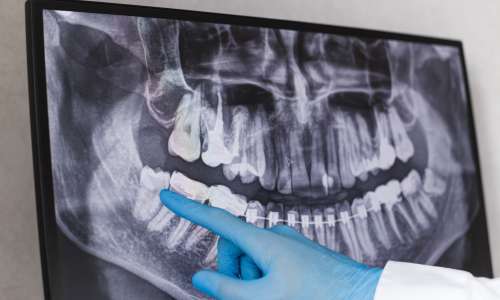 Ko zob povzroča vnetje, zatekanje ter bolečine