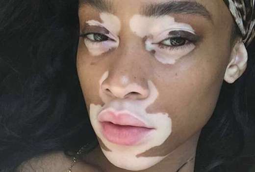 winnie harlow